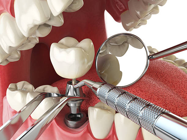 Best Urgent Tooth Repair  in Montclair, CA